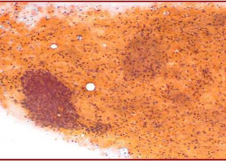 Highly cellular smear; mixture of cluster and dispersed cells