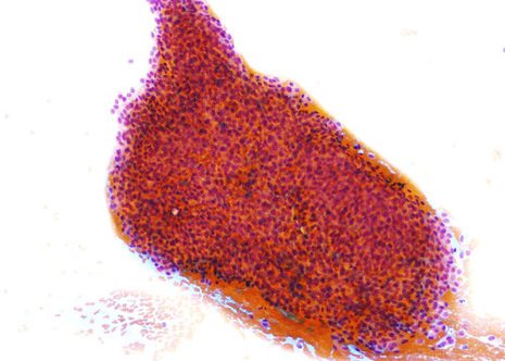 A dense epithelial cellular mass composed of tightly packed small cuboidal cells.