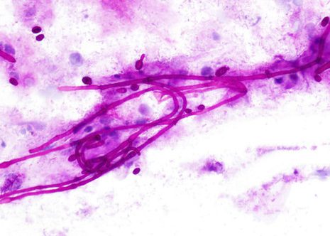 Budding yeasts and pseudohyphae of saprophytic Candida Albicans. Esophageal brushing PAS stain