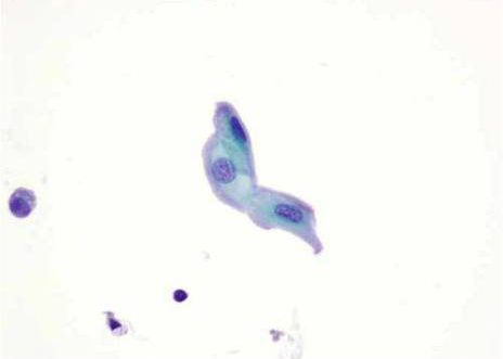 Normal urotelial cells slightly elongated cell shapes. Papanicolaou stain