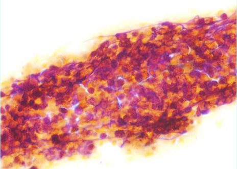 Aggregate of small cells with a small amount of cytoplasm with pleomorphism and high nuclear cytoplasmic ratios.