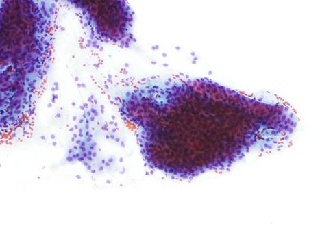 Plaque of parabasal cells in an atrophic sample. The cytoplasm of some cells has degenerated presenting some free nuclei in the extended.