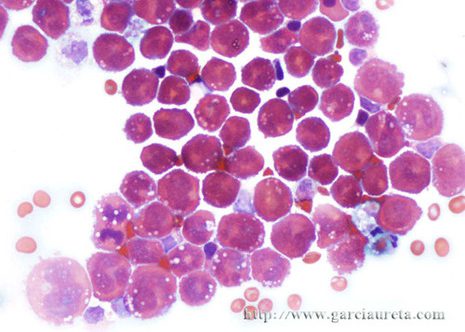 A monomorphic population of large cells shows rounded nuclei and scant cytoplasm.