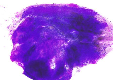 Mixoid stromal tissue contain darker groups of ductal cells. The stroma is intensely staining which has no recognizable cells.