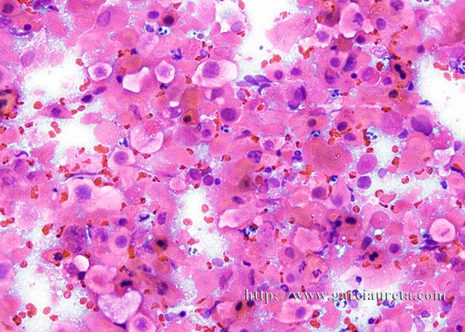 Pleomorphic cells with dense cytoplasm and irregular nuclear shape.