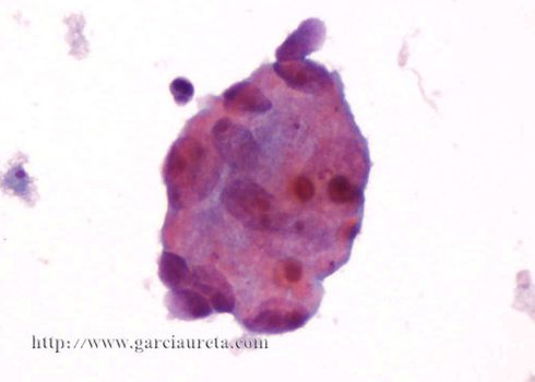 Adenocarcinoma-like cluster of large malignant cells with large nuclei and macronucleoli.