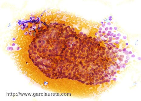 Cluster of carcinoma cells with smooth external contour and peripheral palirading of nuclei.