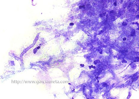 Aspergillus hyphae in brochial lavage fluid. The hyphae are septate with dichotomous branching. M G G stain.