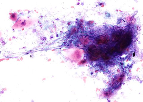 Budding yeasts and pseudohyphae of Candida Albicans. Esophageal brushing Papanicolaou stain