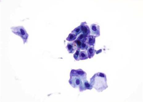 Reactive urothelial cells. Two clusters of benign, degenerated urothelial cells, the nuclei vary in size and are hyperchomatic. Papanicolaou stain.