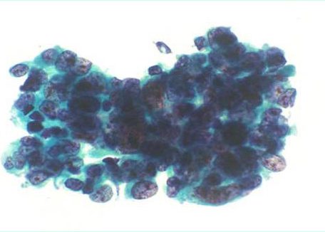 Cluster of atypical epithelial cells with hyperchromasia and abnormal chromatin distribution.