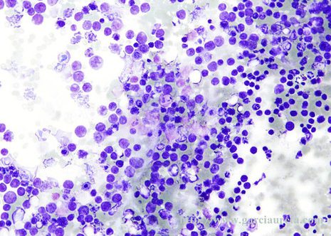 Pleural fluid cytologic specimen showing large cells in a dirty background.