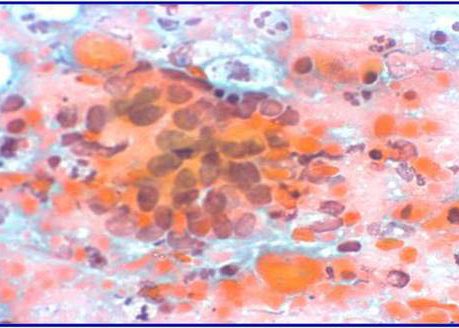 Cells showing cytoplasmic keratinisation.