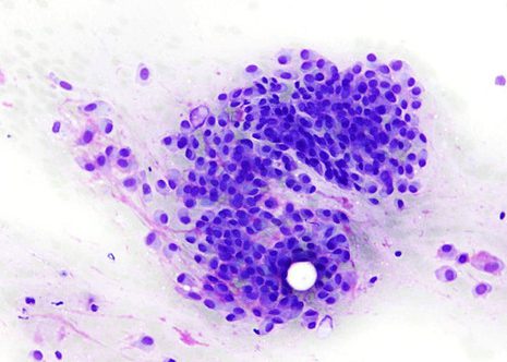 Células mostrando apariencia plasmocitoide con citoplasma denso de bordes precisos e núcelo excéntrico.