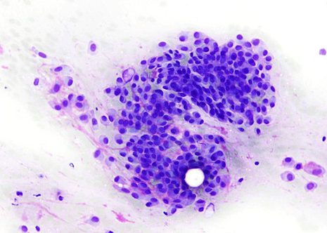 Some cells shows characteristic plasmacytoid-appearing cells with eccentrically placed nuclei dense cytoplasm and distinct cytoplasmic borders.