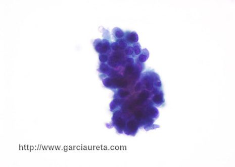 Cell cluster with irregular nuclear arrengement and slight nuclear pleomorphism.