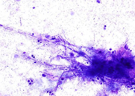 Budding yeasts and pseudohyphae of Candida Albicans. Esophageal brushing M.G.G. stain