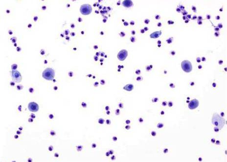 Bening transitional cells admixed with inflammatory cells.