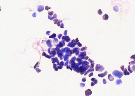 Small loose clusters showing absence of cytoplasm and showing nuclear molding.