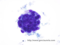 ADENOCARCINOMA DE ESTOMAGO METASTASICO EN LIQUIDO PLEURAL