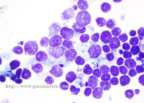 Moitas das células mostran vacuolas citoplasmáticas.