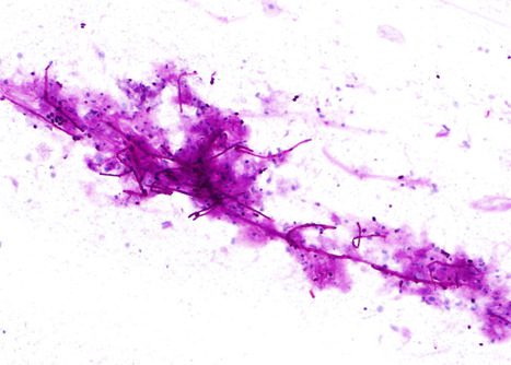 Budding yeasts and pseudohyphae of Candida Albicans. Esophageal brushing PAS stain