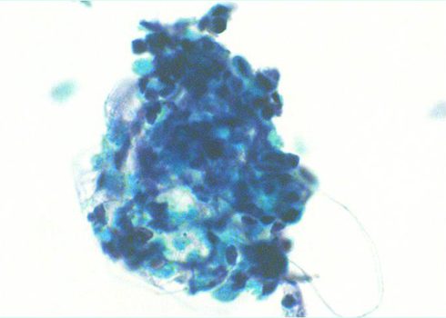 The tumor cells exhibit small cytoplasm coarse chromatin and necrosis.