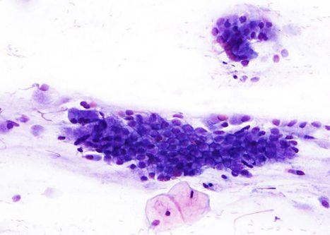 Sheet of columnar cells. Sharply outlined cytoplasmic boundaries create a honey comb pattern.