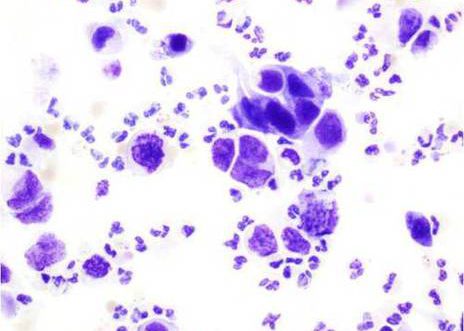 Carcinoma de células transicionais. Células maliñas pleomórficas, hipercromáticas con citoplasma denso e núcleo excéntrico.