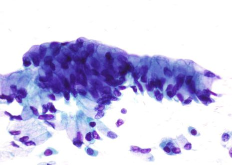 Células endocervicais con morfoloxía caliciforme pola distensión con mucina.