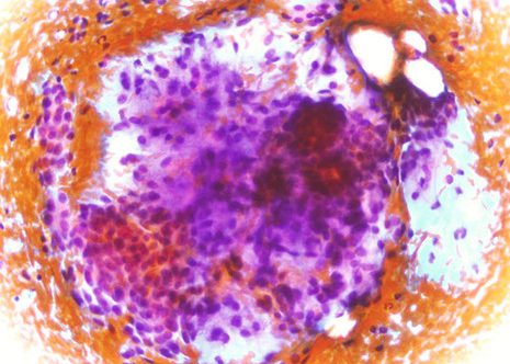 Mixture of epithelial and myxomatous elements.