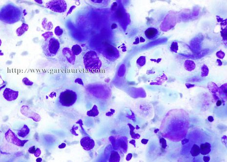 Malignant squamous cells showing marked nuclear and cytoplasm pleomorphism.