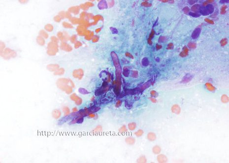 Aspergillus hyphae in brochial lavage fluid. The hyphae are septate with dichotomous branching. Papanicolaou stain.