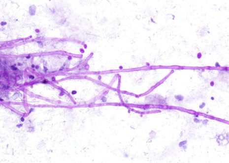 Characteristic branching hyphal fragments with septa. Esophageal brushing Papanicolaou stain