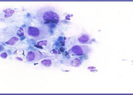 Disorganised sheet of tumor cells with nuclear atypia.