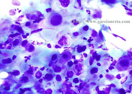 Células maliñas con núcleos hiepercromáticos de tamaño variabel con aumento da relación N/C e irregularidades na membrana nuclear.