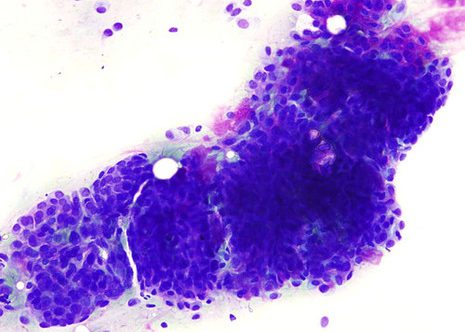 Epithelial cell predominance the degree of nuclear pleomorphism here non suggested malignancy.