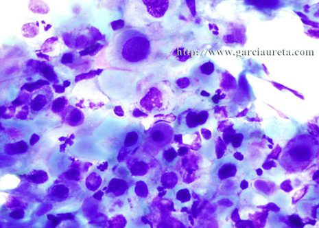 Malignant squamous cells showing nuclear size variation, hypercromasia, markedly increased N/C ratio and irregular nuclear membrane