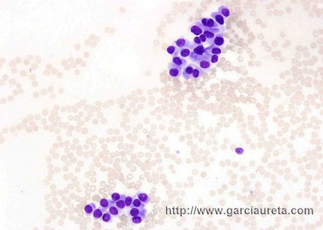 Polygonal cells with dense cytoplasm; some nuclei with small internuclear cytoplasmic inclusions (MGG. stain)