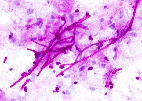 Characteristic branching hyphal fragments with septa. Esophageal brushing PAS stain