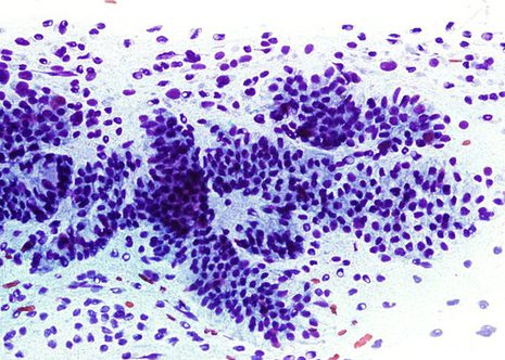 Bare nuclei are frequently seen around endocervical cell groups.