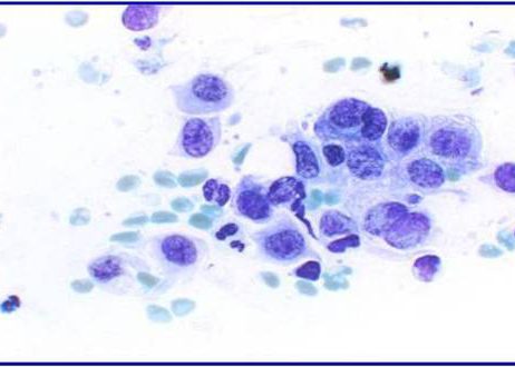 Cells with prominente nucleoli