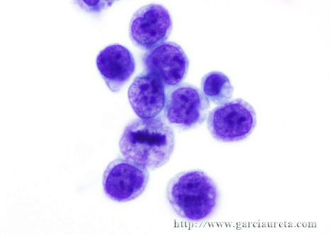 Many cells show prominent nucleoli and irregular nuclear membranes.