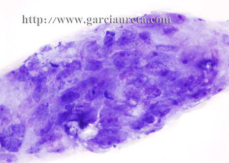 Acúmulos de células tumorais con nucleolos prominentes.