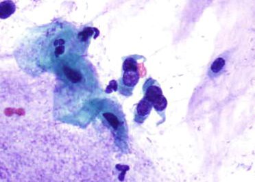 Células endocervicais ciliadas.