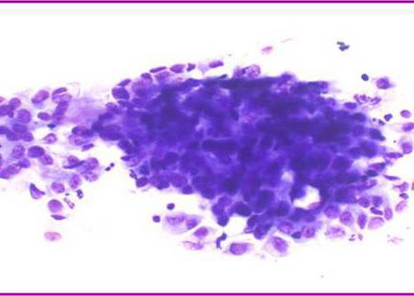 Núcleos redondeados con aspect vesiculoso e nucléolo evidente.