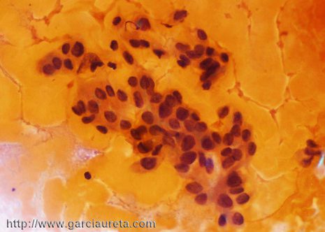 Acúmulo de células foliculares pouco cohesivas con núcleos agrandados e algunhas fendiduras lonxitudinais (Tinción Pap)