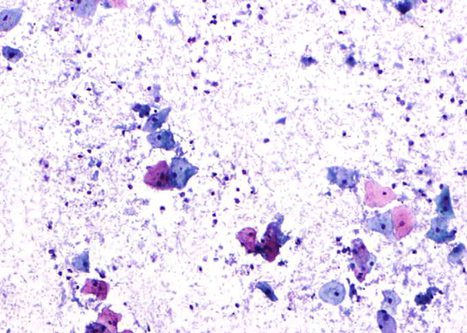 Cytolisis. Bare nuclei are due to lysis of the cytoplasm. Döderlein bacilli are conspicuous.