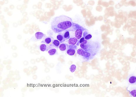 Dissociated polygonal and cilindrical tumor cells. Tthe nuclei vary in size and shape. (MGG stain)