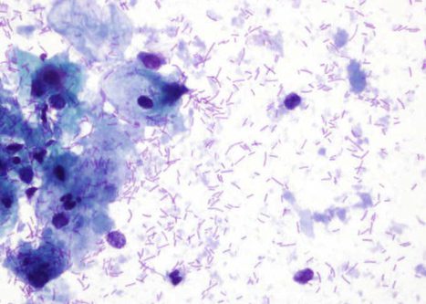 Numerous Döderlein bacilli in a cytolytic smear with intermédiate cells an free nuclei.